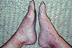 Hundreds of mosquito and sand flea bites on feet
